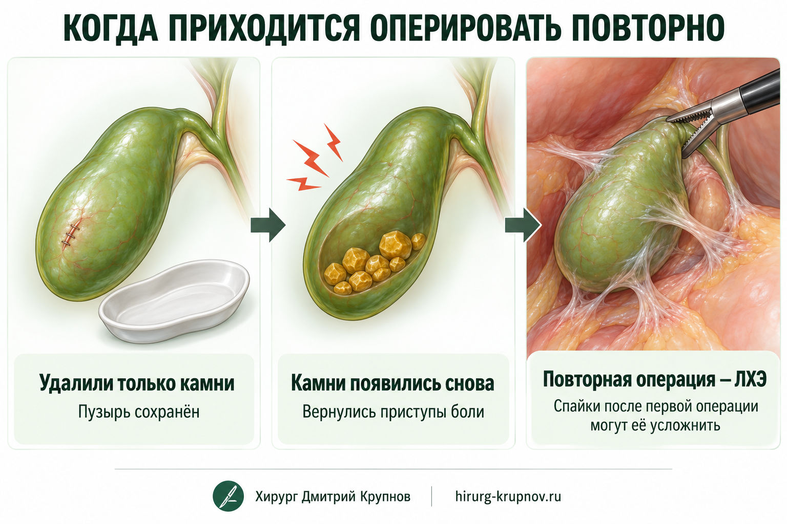 Повторная операция после появления камней