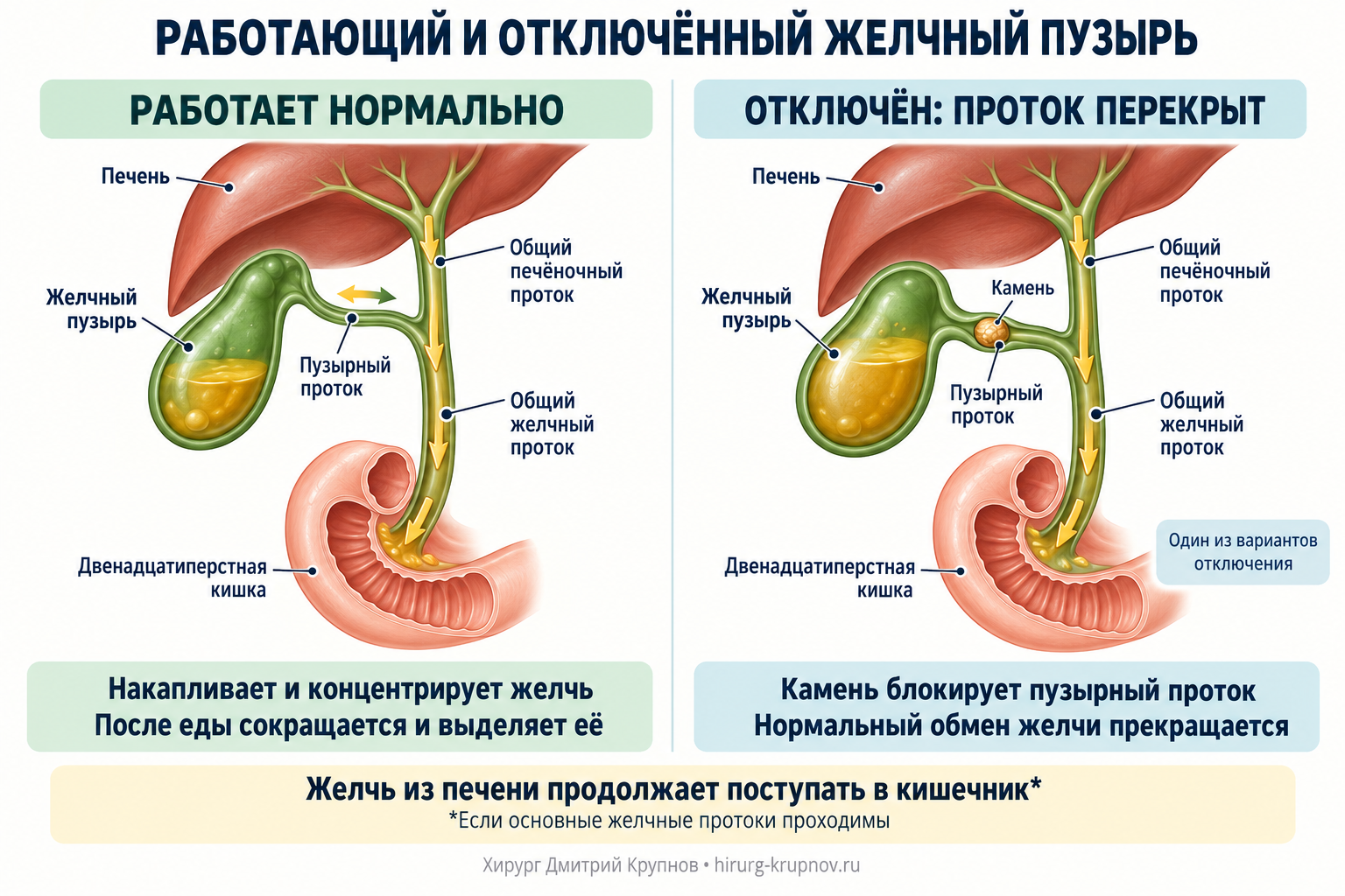 Отключенный желчный пузырь. Отличие от работающего