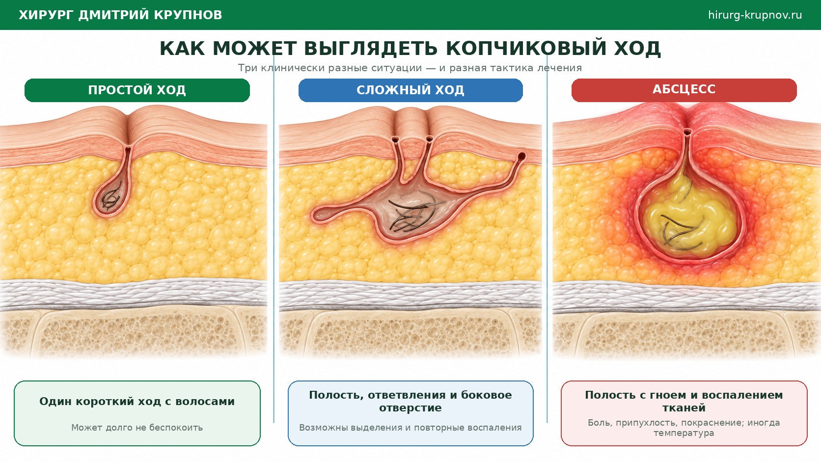 Эпителиальный копчиковый ход. Варианты: простой ход, сложный ход, абсцесс копчика.
