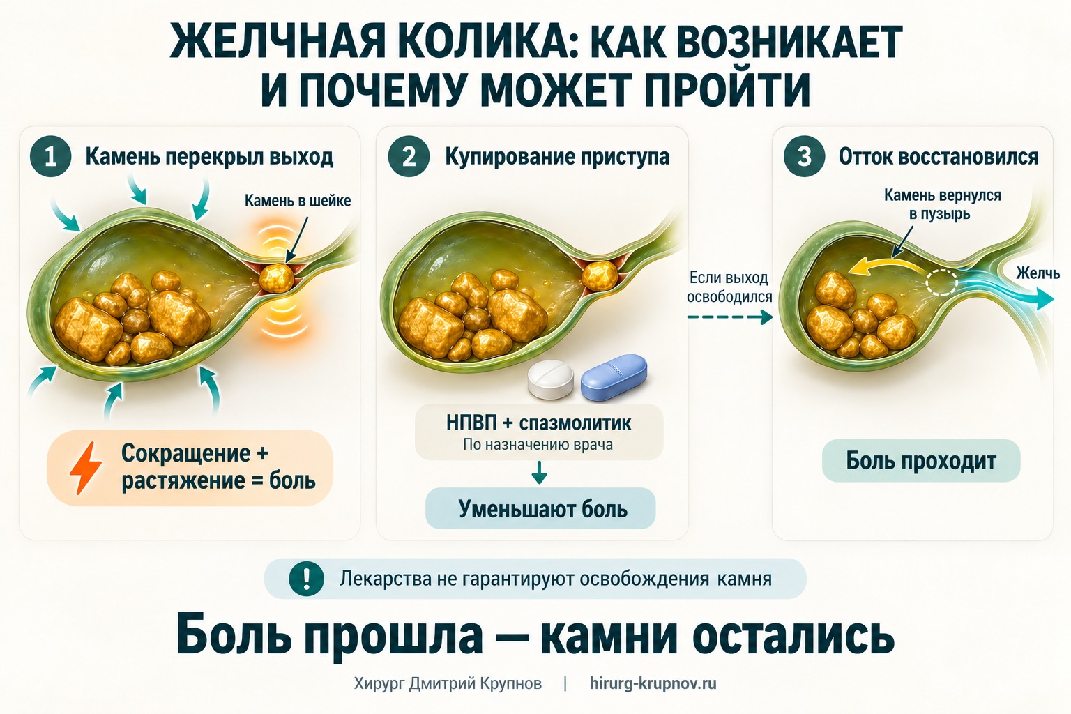 Желчная колика: камень перекрывает шейку желчного пузыря, вызывает повышение давления и боль; при возвращении камня в полость пузыря отток желчи восстанавливается.