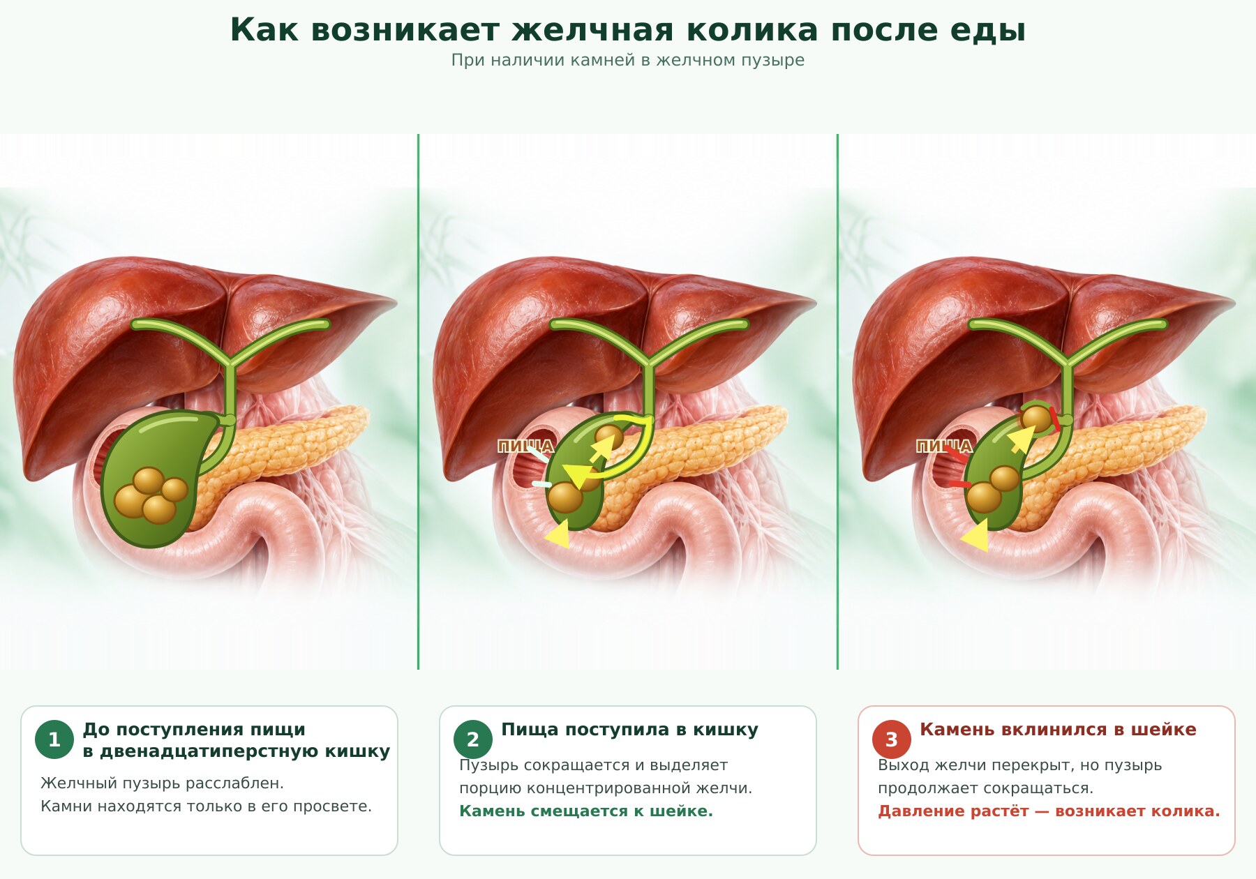 Как жирная пища может спровоцировать желчную колику при камнях в желчном пузыре