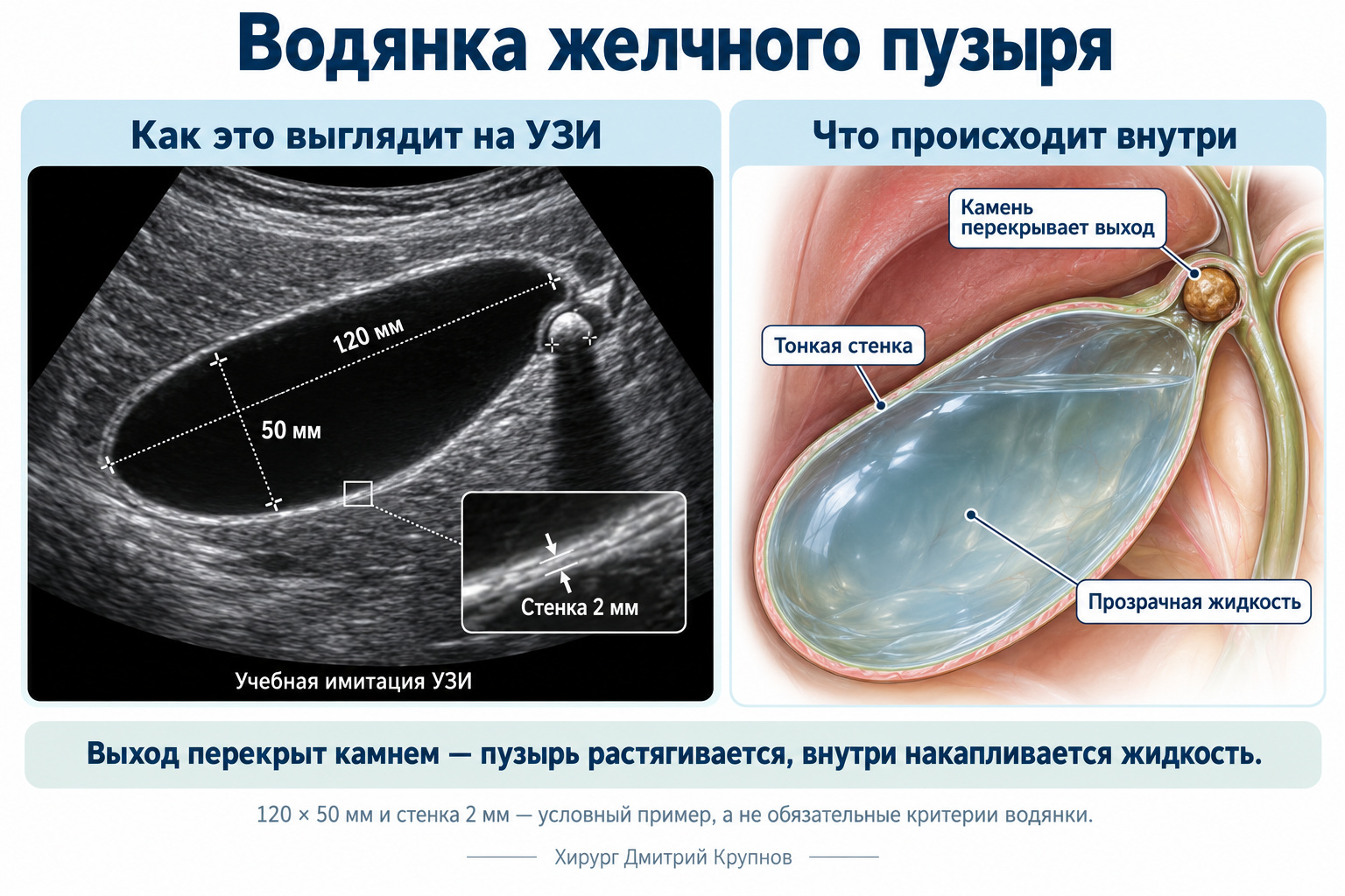Водянка желчного пузыря на узи