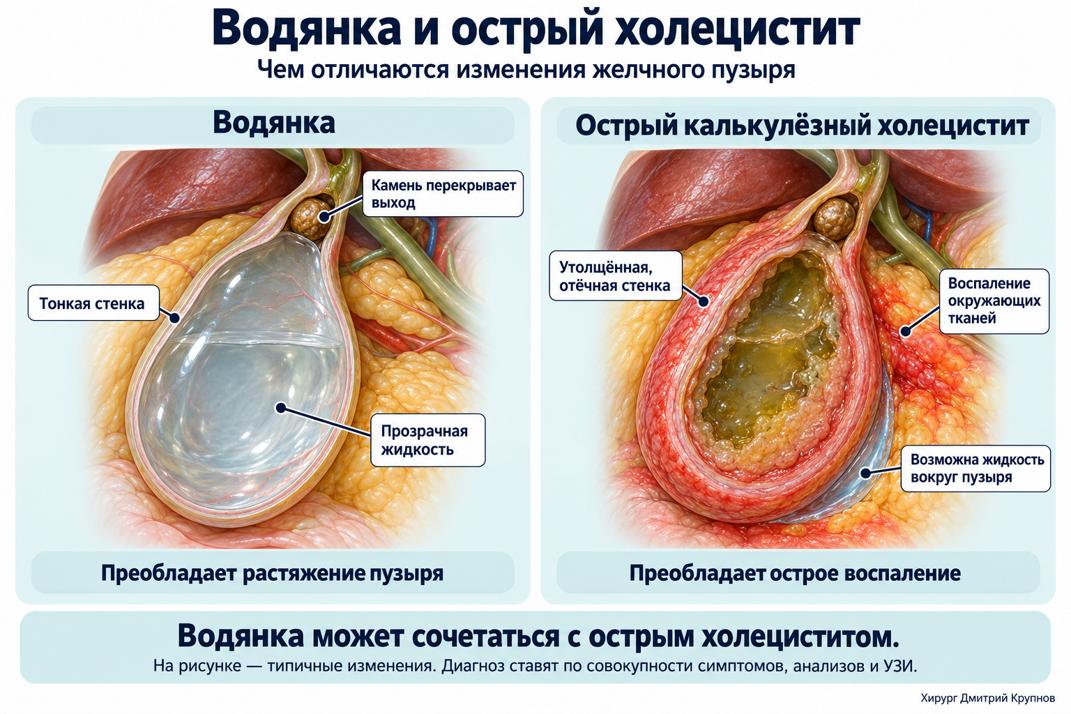 Отичие водянки желчного пузыря от острого калькулезного холецистита